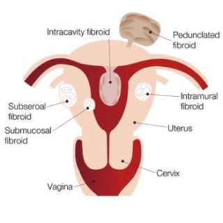 Uterine Fibroids Raffles Women S Centre Singapore