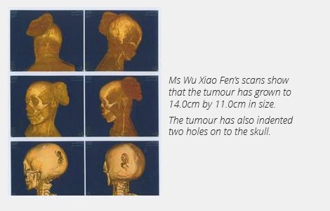 ms wu xiao fen scan of her tumour condition