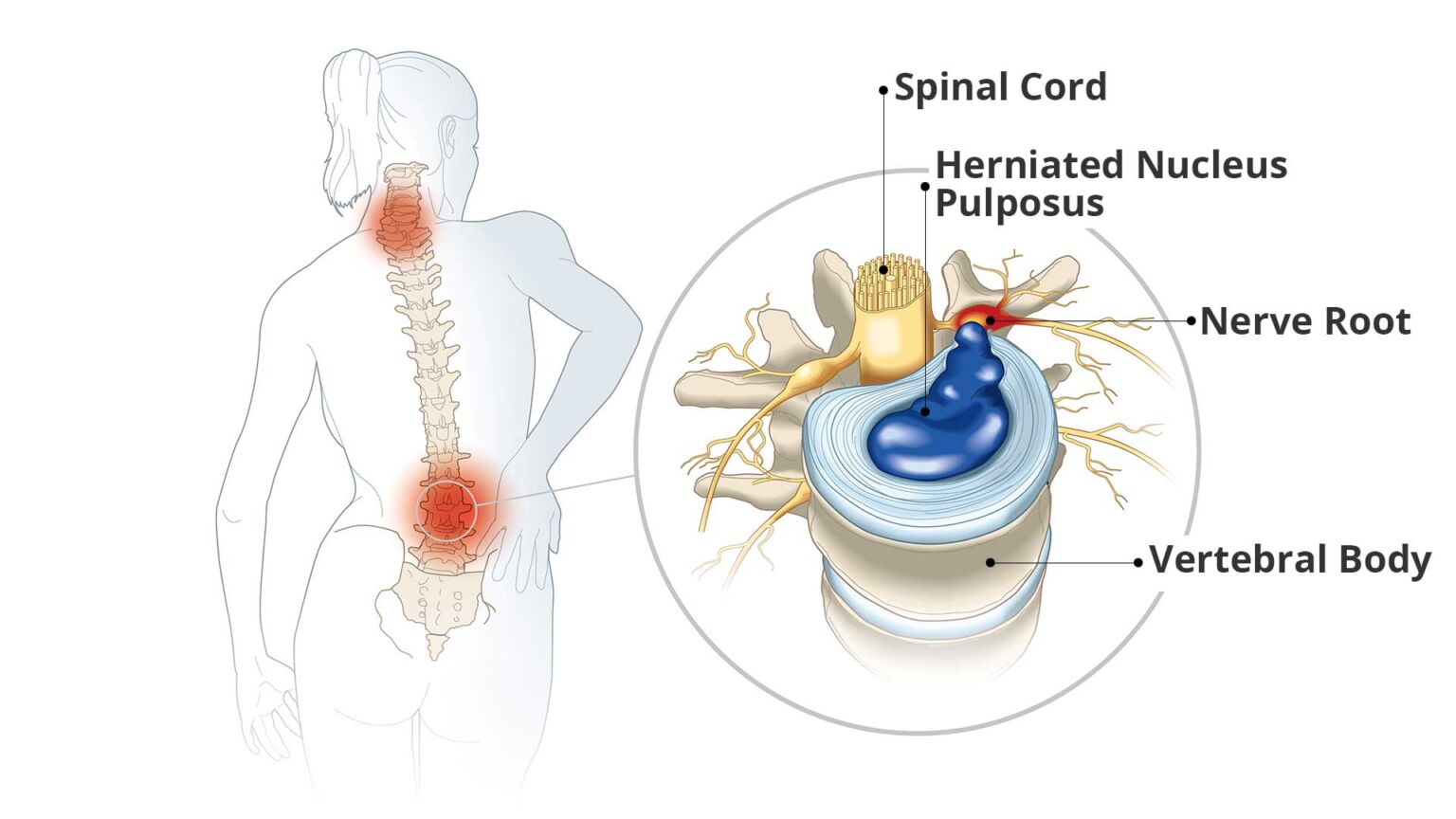 Slipped Disc » Raffles Orthopaedic Centre, Singapore