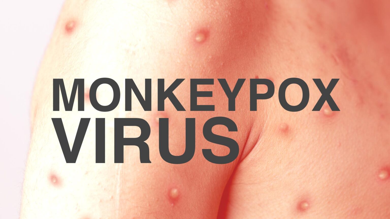 What is Monkeypox? » Cases in Singapore » Raffles Medical Group