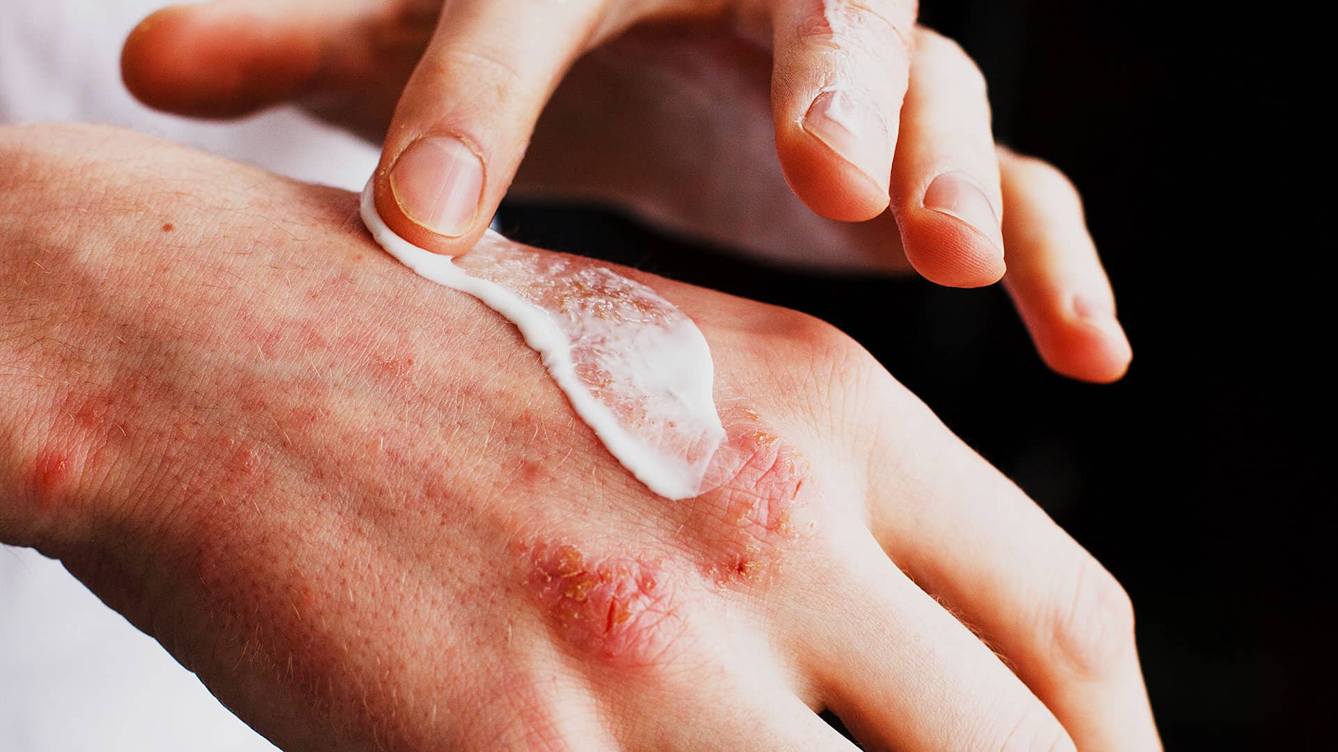 Moisturisers should be applied on affected area eczema