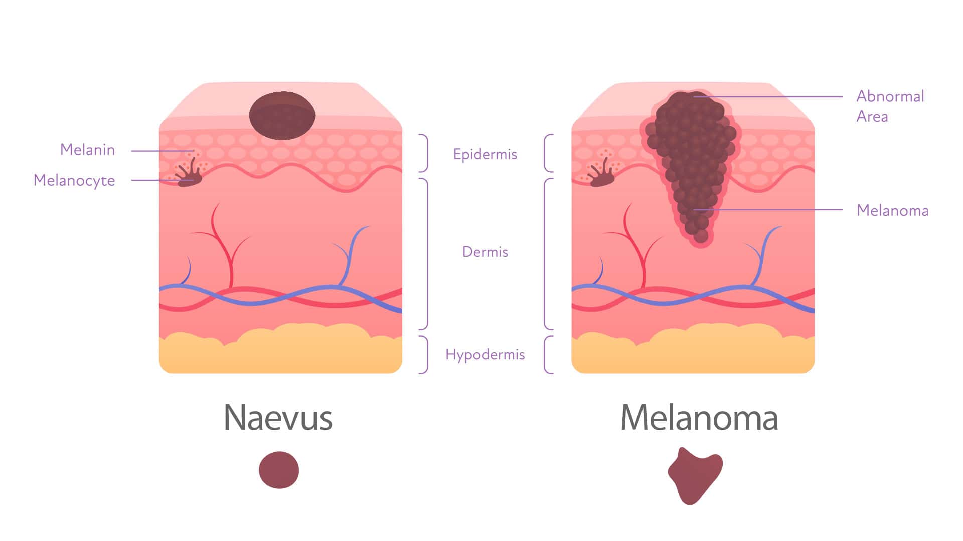 comparison of melanoma and common moles