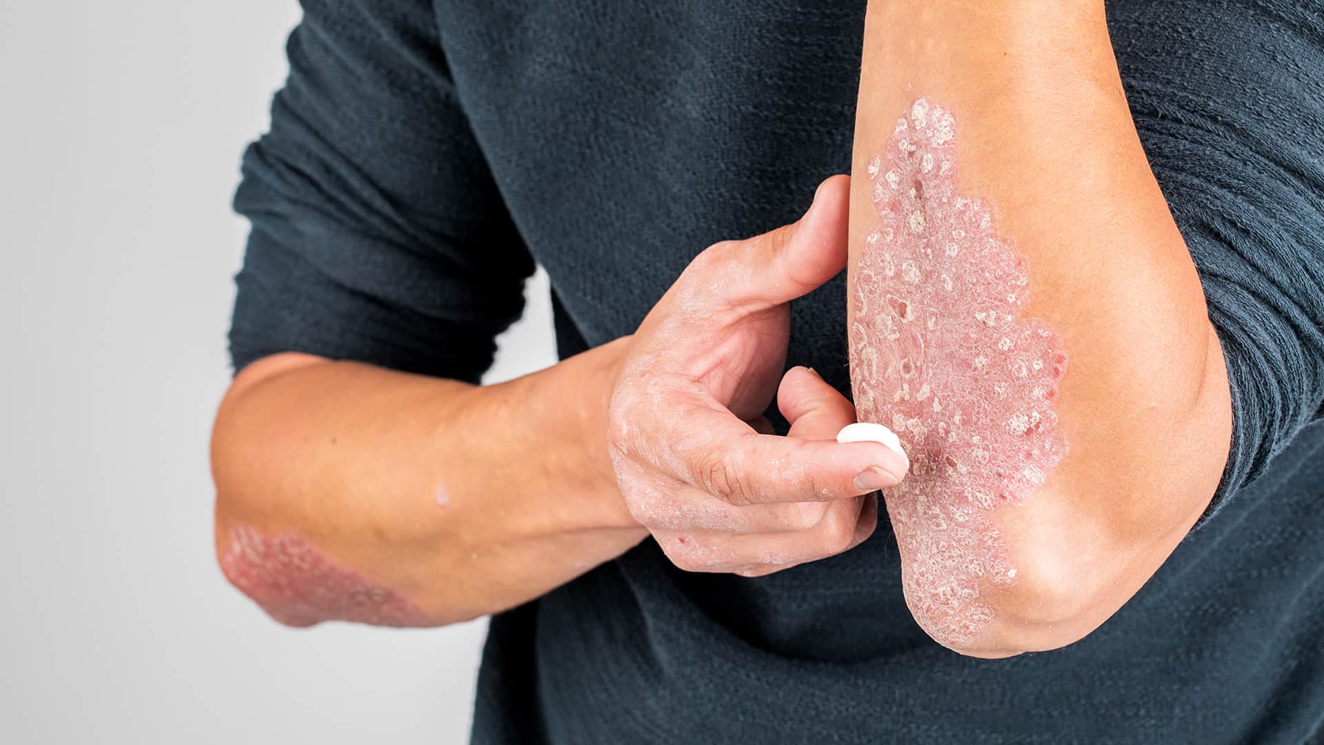 psoriasis conditions -apply topical creams or ointments on affected areas