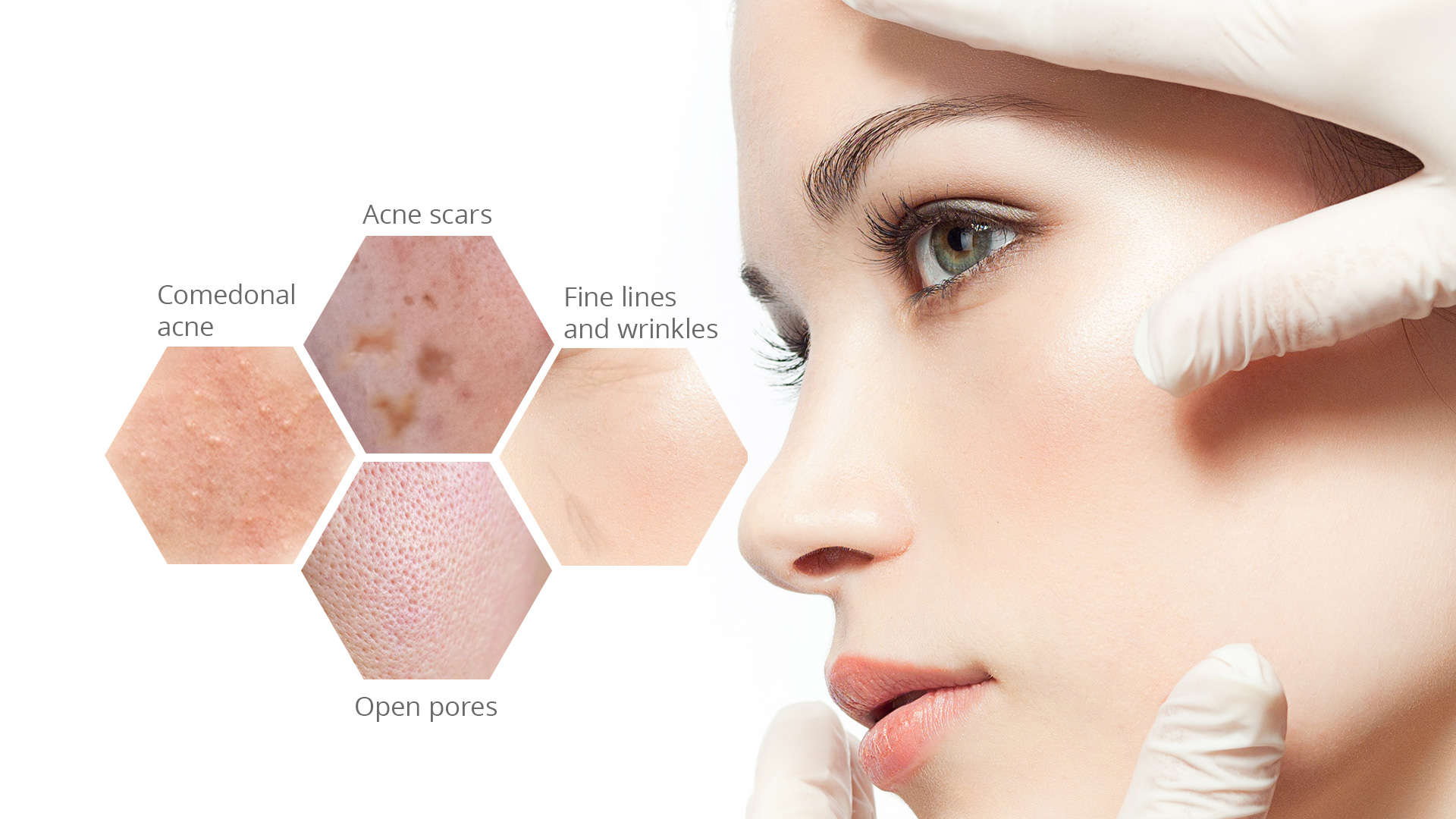 skin conditions for chemical peel