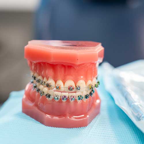 Braces orthodontics treatment