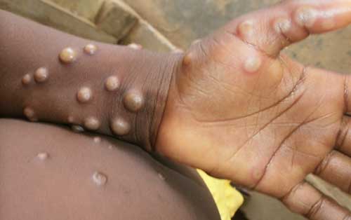 mpox rash signs WHO international source image